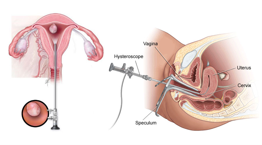 Hysteroscopic Surgeon in Kolkata