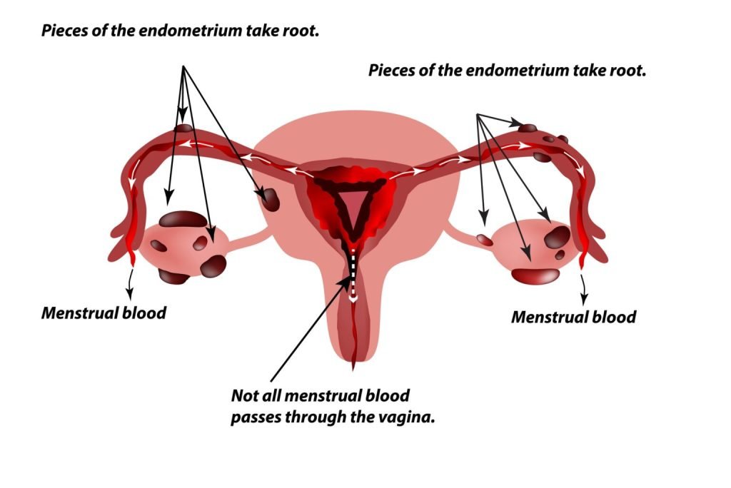 best endometriosis specialist in kolkata