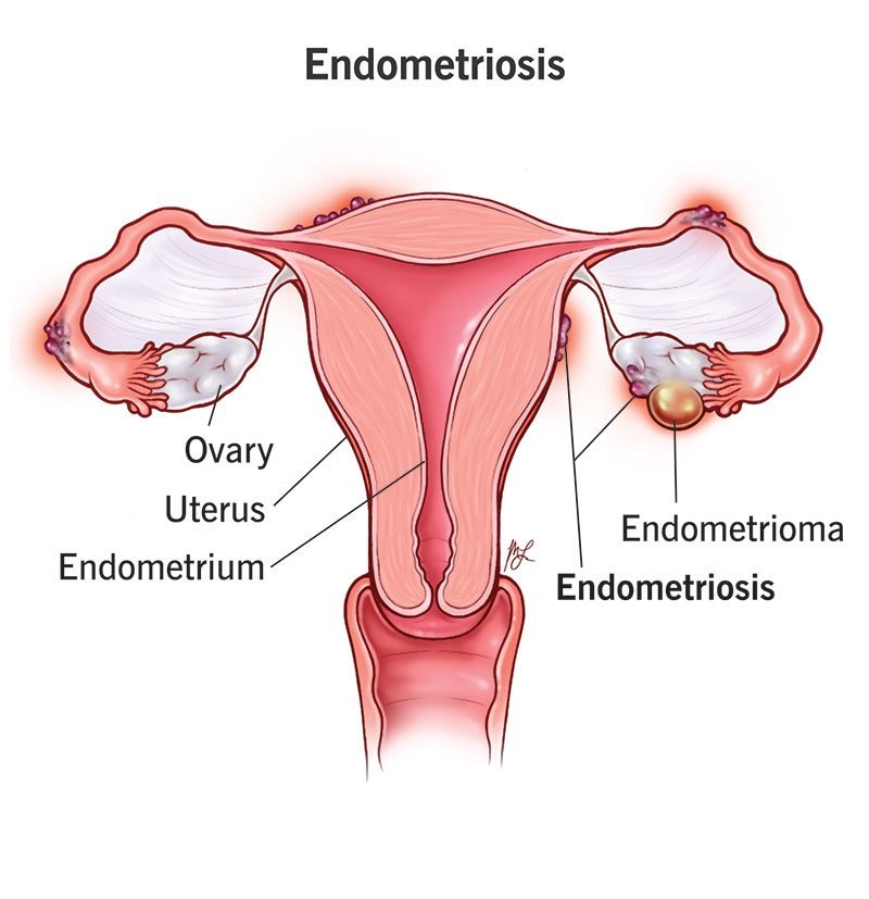 endometriosis surgeon in kolkata