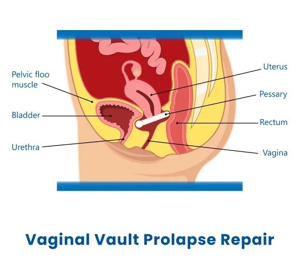 Laparoscopic Repair of Vault Prolapse