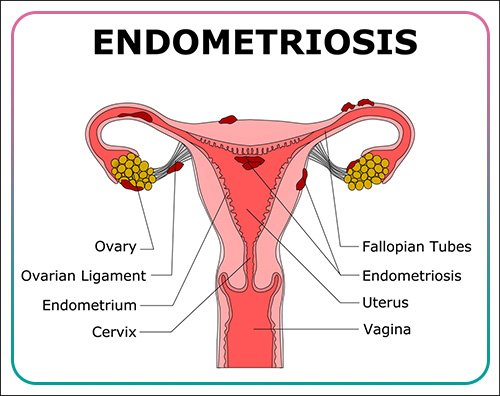 best endometriosis specialist in kolkata