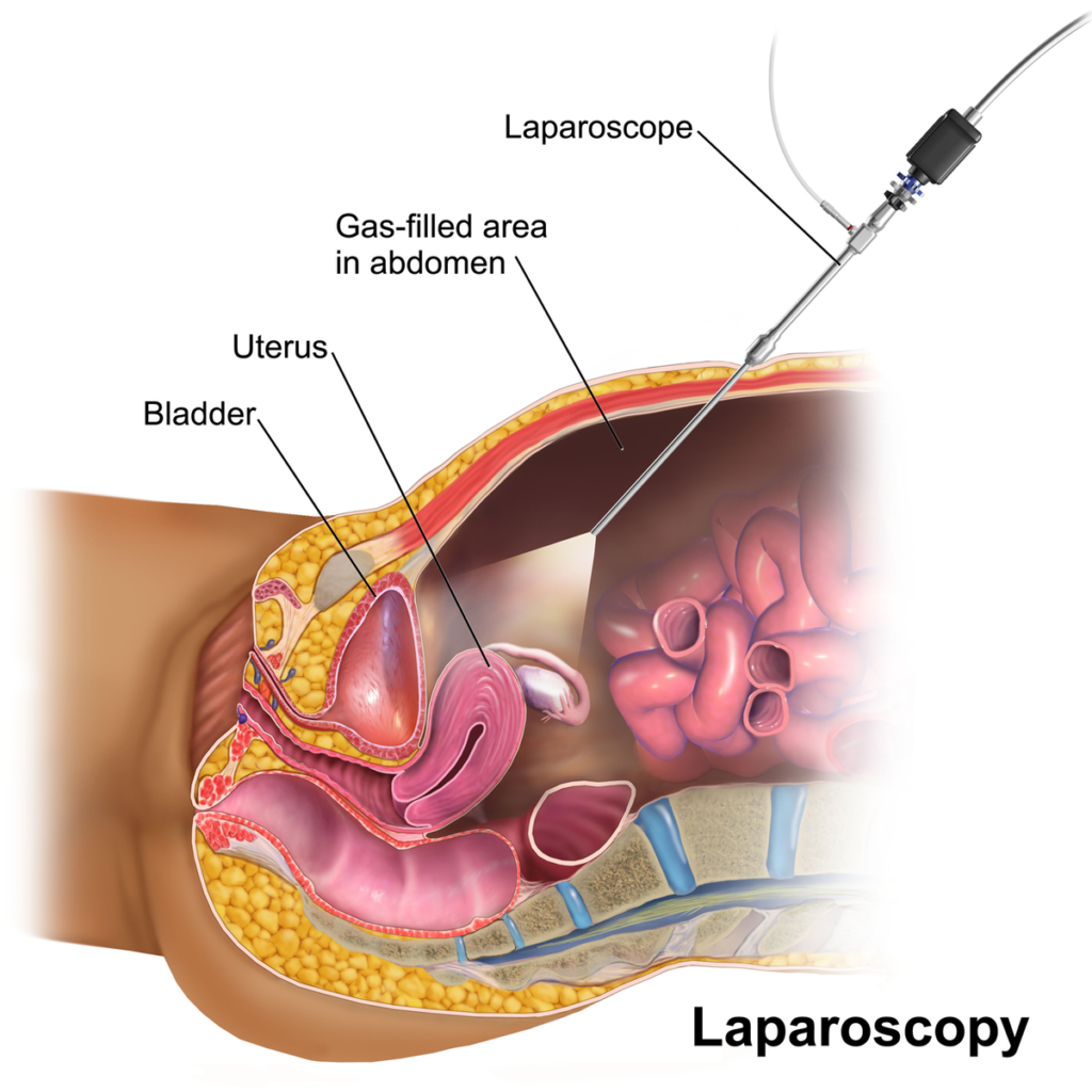 gynae laparoscopic surgery in Kolkata