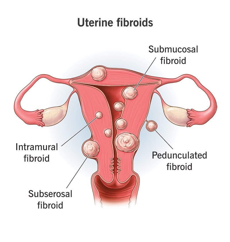 fibroid in pregnancy risks