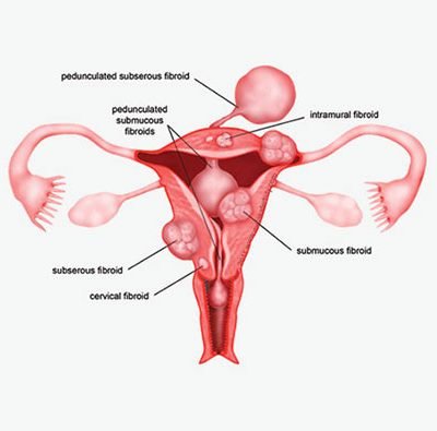 Laparoscopic Myomectomy surgeon in India, West Bengal, Kolkata